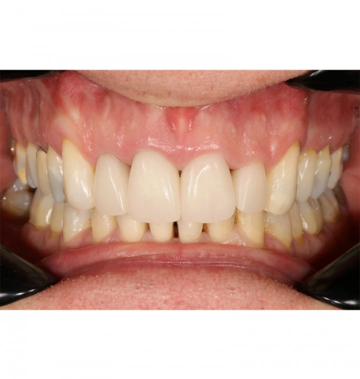 Black Metal Cheek Retractors thumbnail 3